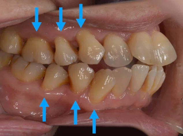 [Dentist Explains] Sharp pain from cold things! The 5 major causes and ...