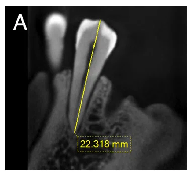 Tooth 18 Radiograph On Determining Working Length (For Dentists Only)|16-4 米国歯内療法専門医が夢である歯科 ...
