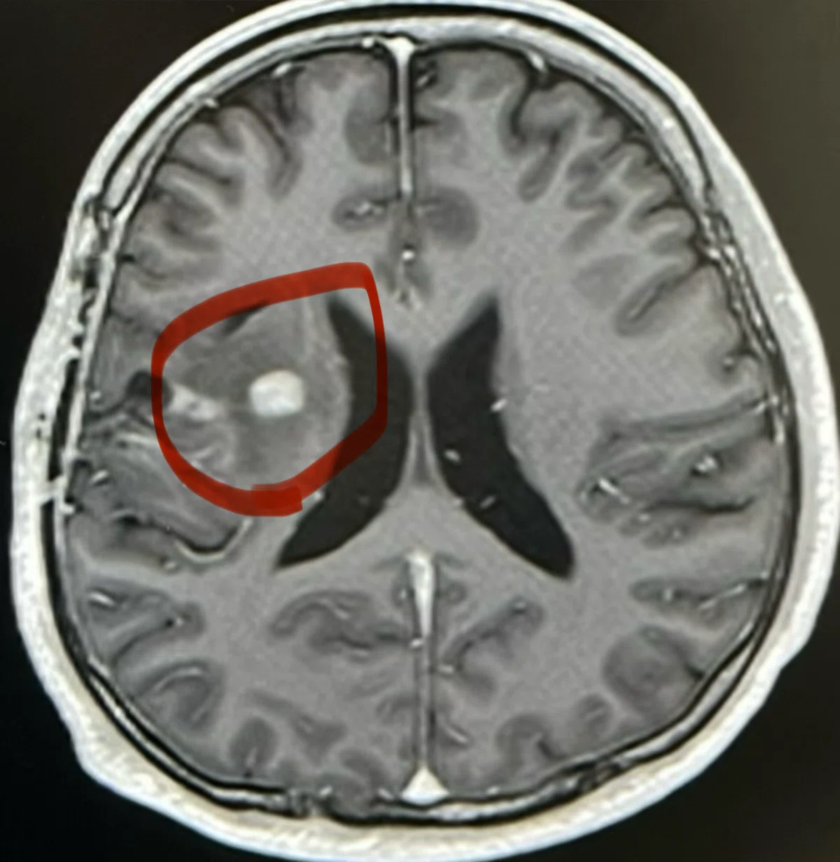 [Living with Glioblastoma Part 3] The real trial began after discharge ...
