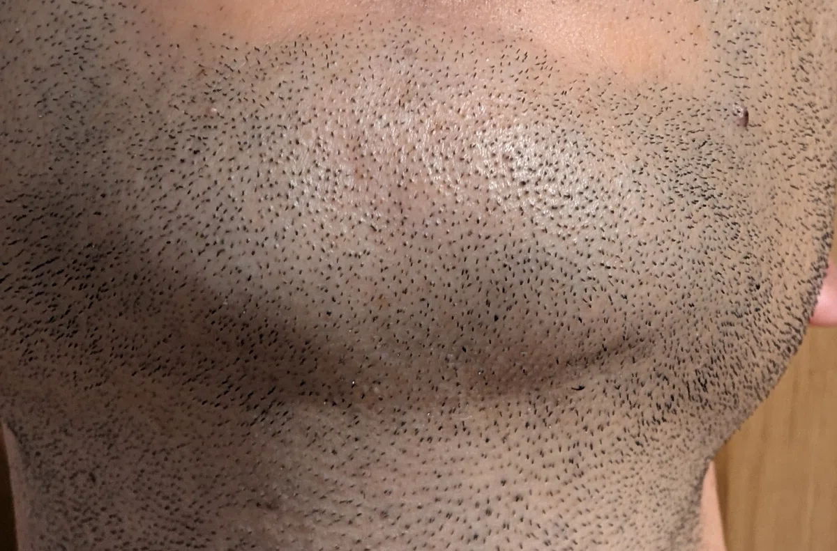 A Forty-Year-Old Man's Medical Hair Removal Diary: I Want to Messi All ...