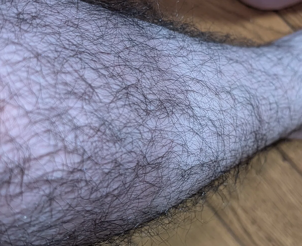 A Forty-Year-Old Man's Medical Hair Removal Diary: I Want to Messi All ...