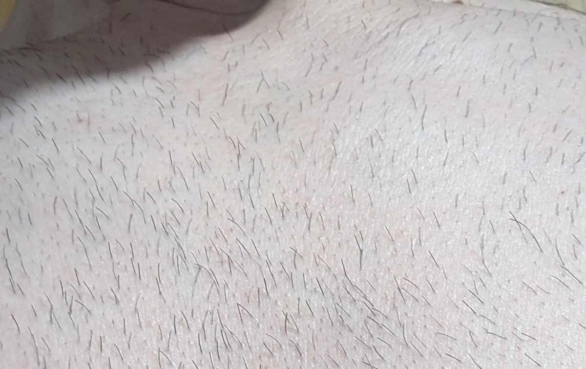 A Forty-Year-Old Man's Medical Hair Removal Diary: I Want to Messi All ...