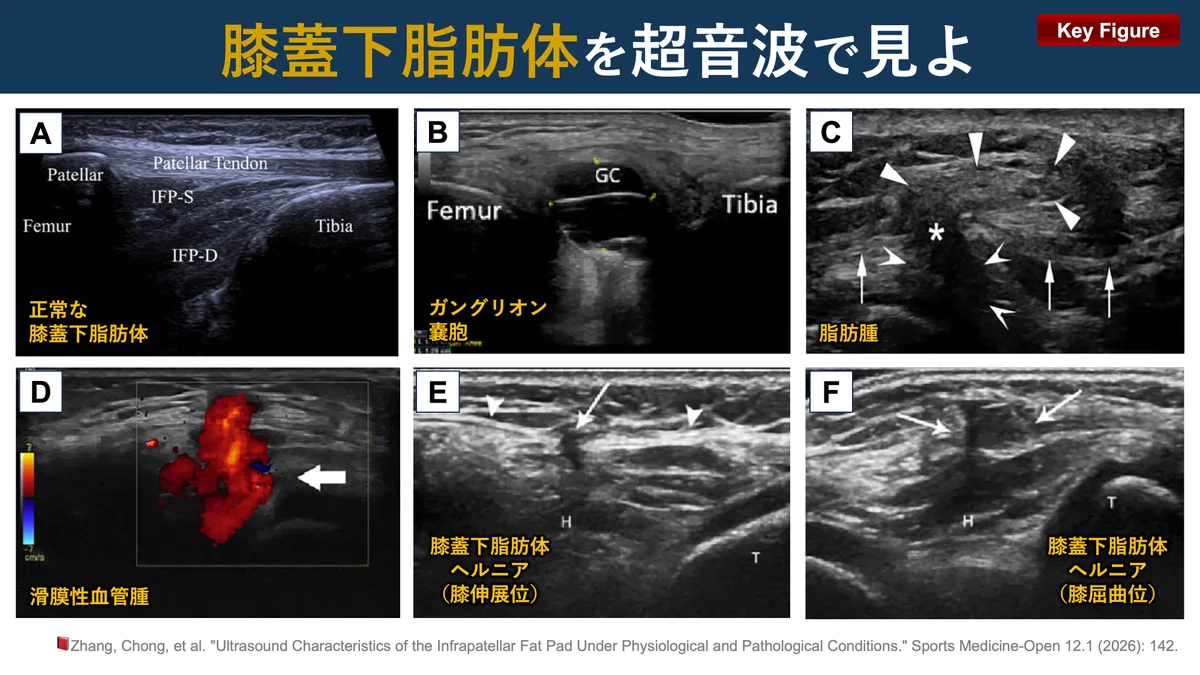Observe the Infrapatellar Fat Pad with Ultrasound｜Super Human | 理学療法士 ...