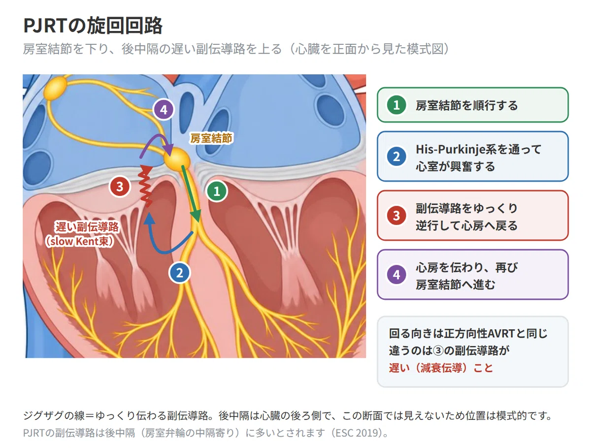 What is PJRT? | Reasons for Long RP Tachycardia and Tachycardia-Induced ...