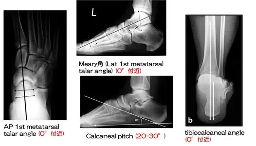 Considering the Treatment of Severe Foot Trauma｜生涯学び続けたい外傷整形外科医の記録
