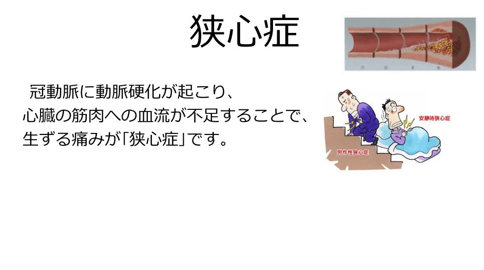 [Introduction to the Cath Lab] What is the purpose of PCI (Percutaneous ...