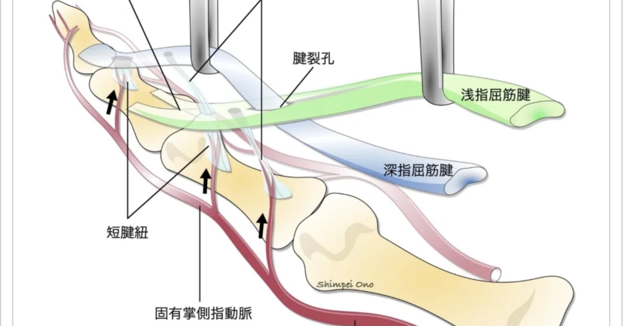 「PIP関節の屈曲拘縮（伸展できない）」＃書く習慣107｜整形外科で働く柔道整復師