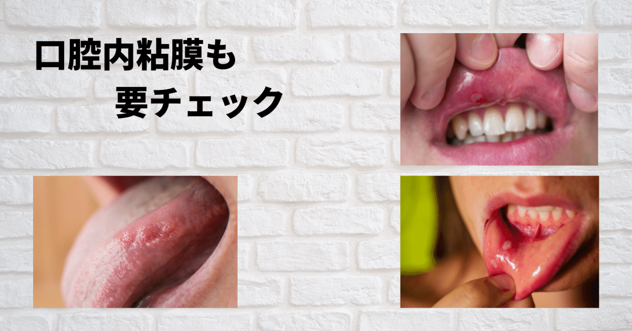 口腔内粘膜も要チェック｜いずみ中山歯科