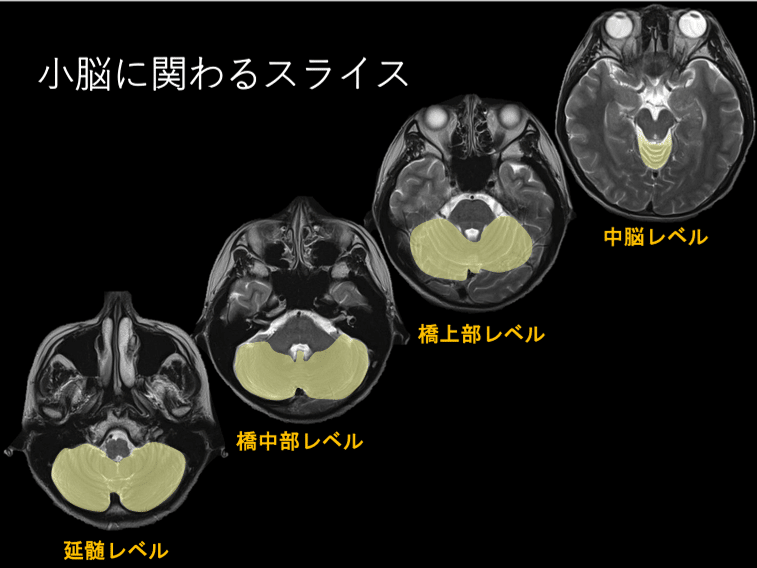 脳画像 小脳機能 小脳が関わる脳画像スライス はらかずみ Note