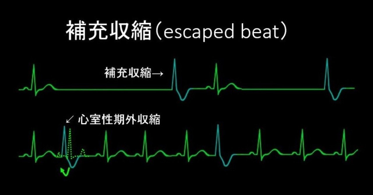 0025.心室性期外収縮じゃないよ!?補充収縮だよ?
