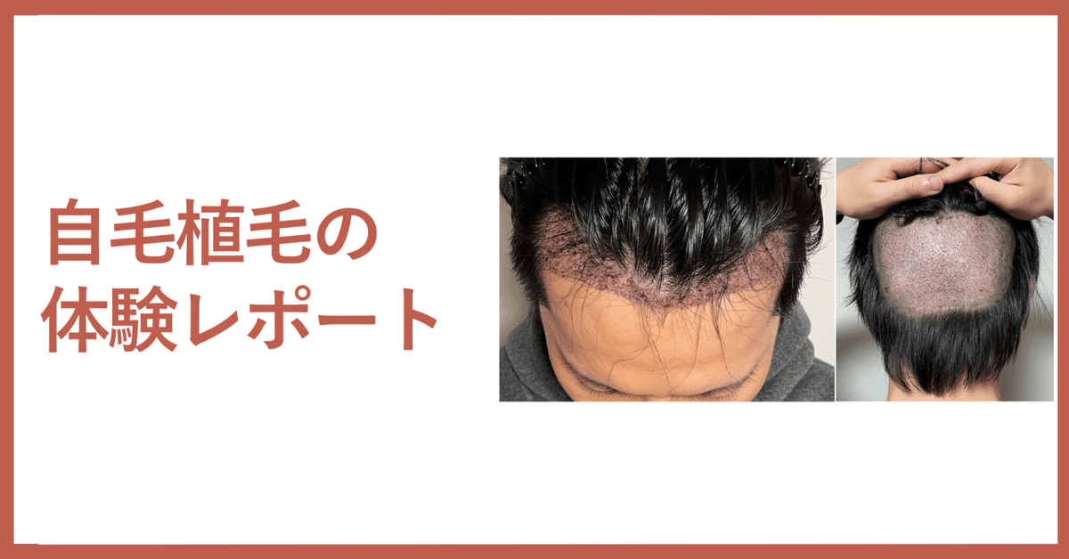 自毛植毛 体験レポート(※2024年8月更新）｜整形社員♂