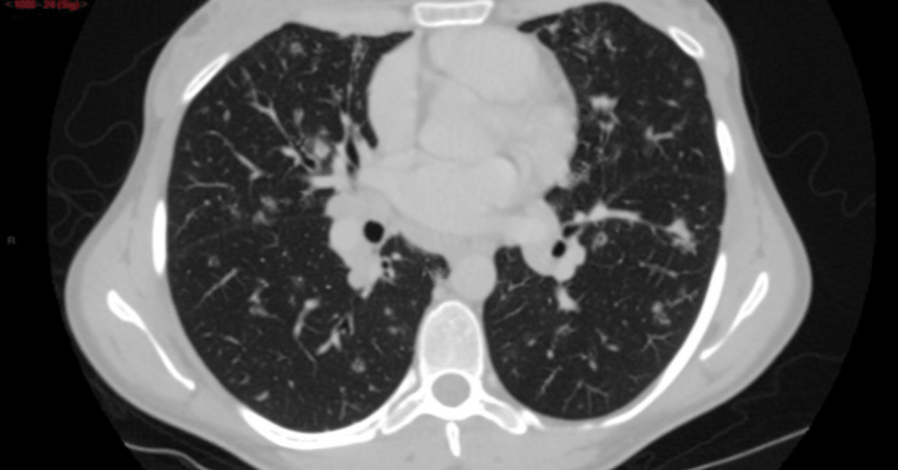 granulomatous lymphocytic interstitial lung disease（GLILD）