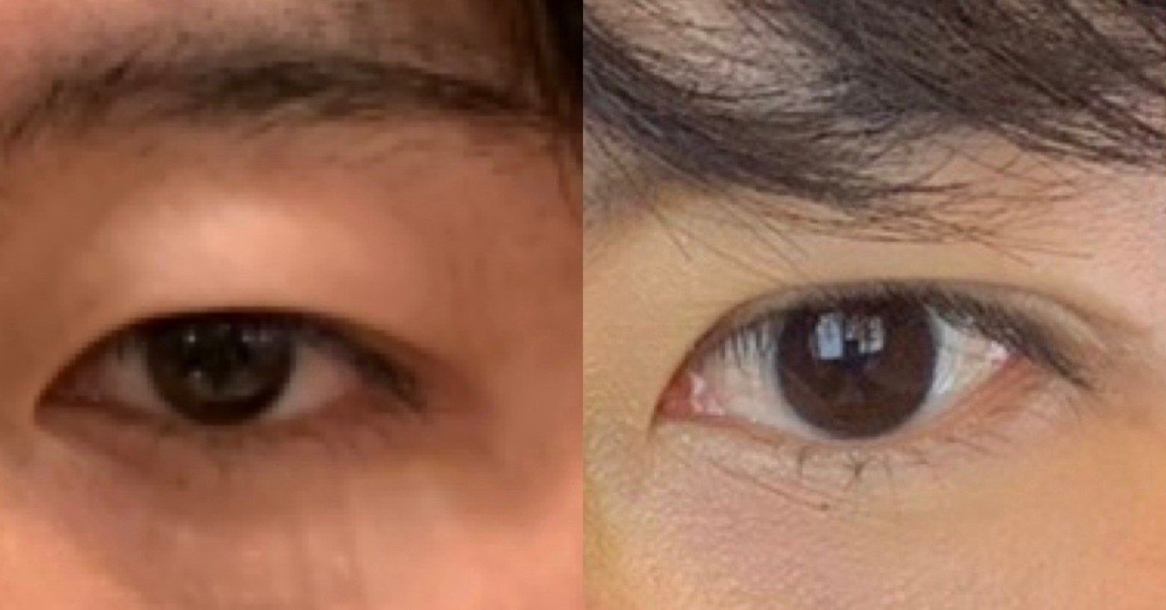 25歳男で二重に整形した体験談 西村マサヤ Note