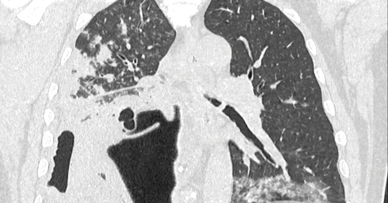 Case2 糖尿病既往のある55歳男性 呼吸困難｜マドラス