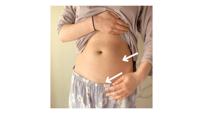 腹腔鏡手術の傷跡（11年後）／卵巣嚢腫／経験談