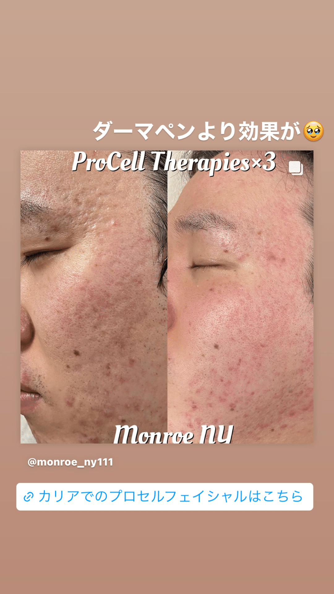 プロセルフェイシャル”解説｜_career_Maiko