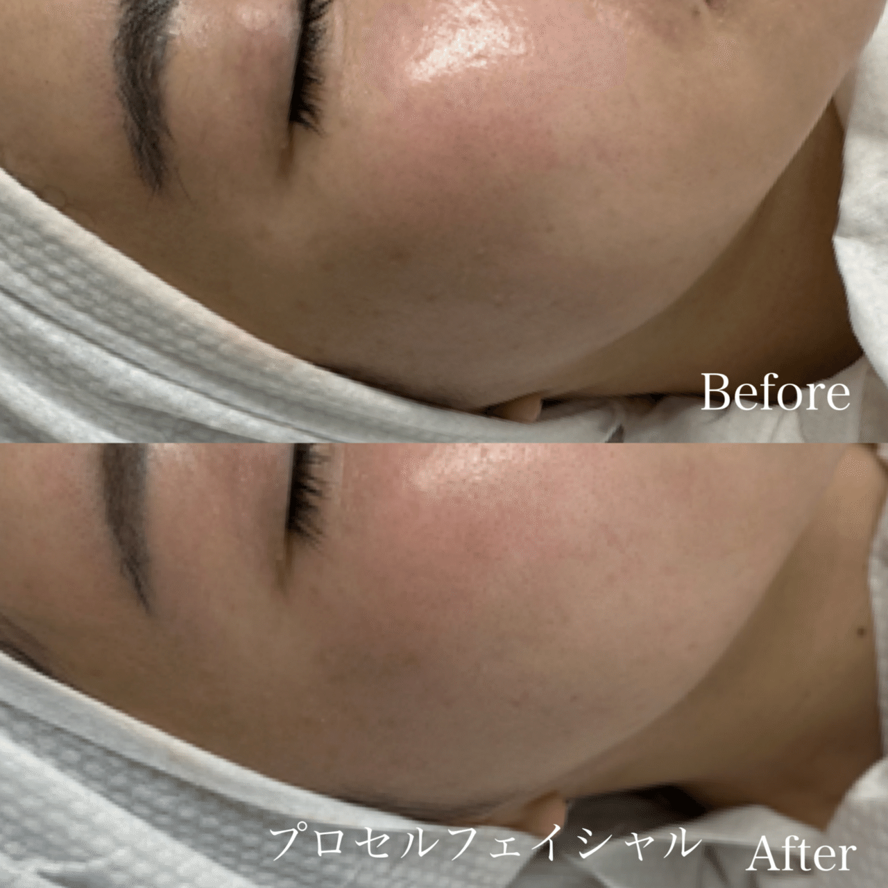 プロセルフェイシャル”解説｜_career_Maiko