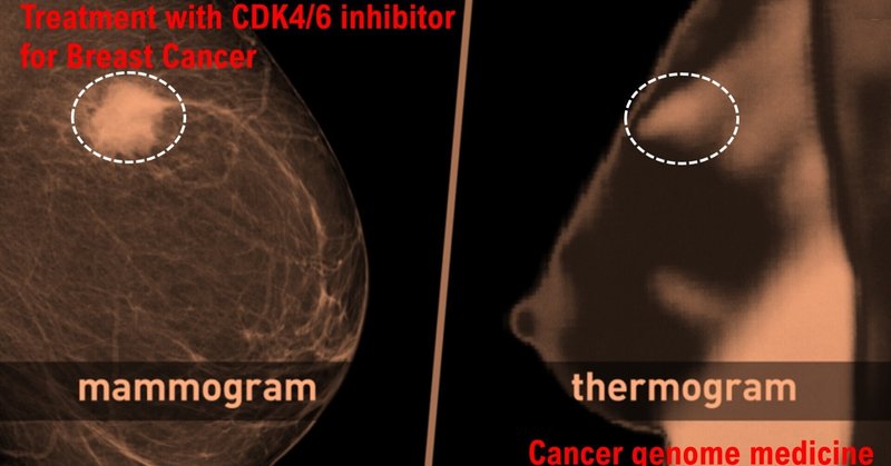 日本の癌ゲノム医療での乳癌患者に対するCDK4/CDK6阻害剤の処方の重要性