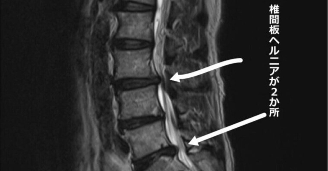 椎間板ヘルニアの手術の種類