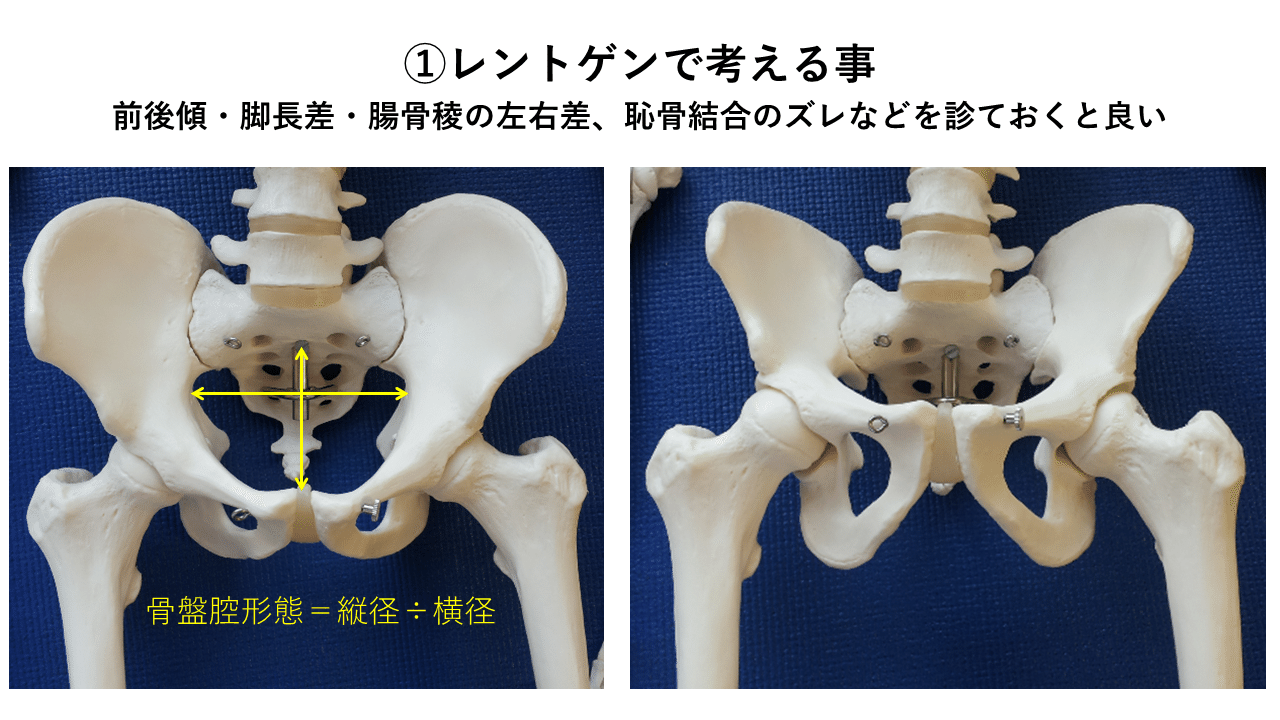 骨盤帯 臨床応用 土屋元明 姿勢と歩きの専門家 Note 骨盤帯 臨床応用 土屋元明 姿勢と歩きの専門家 Note