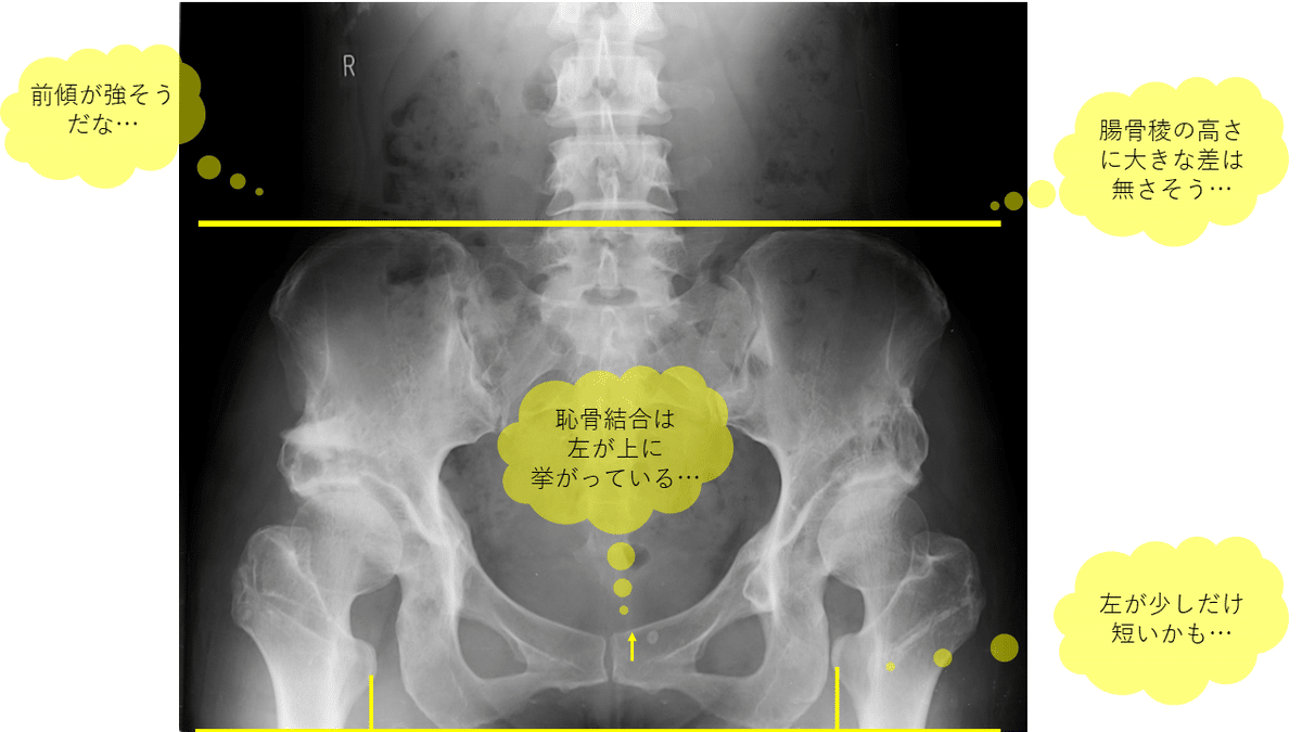 骨盤帯　臨床の専門的技能とリサーチの統合 骨盤帯原著第4版臨床の専門的技能とリサーチの統合 | Diane Lee