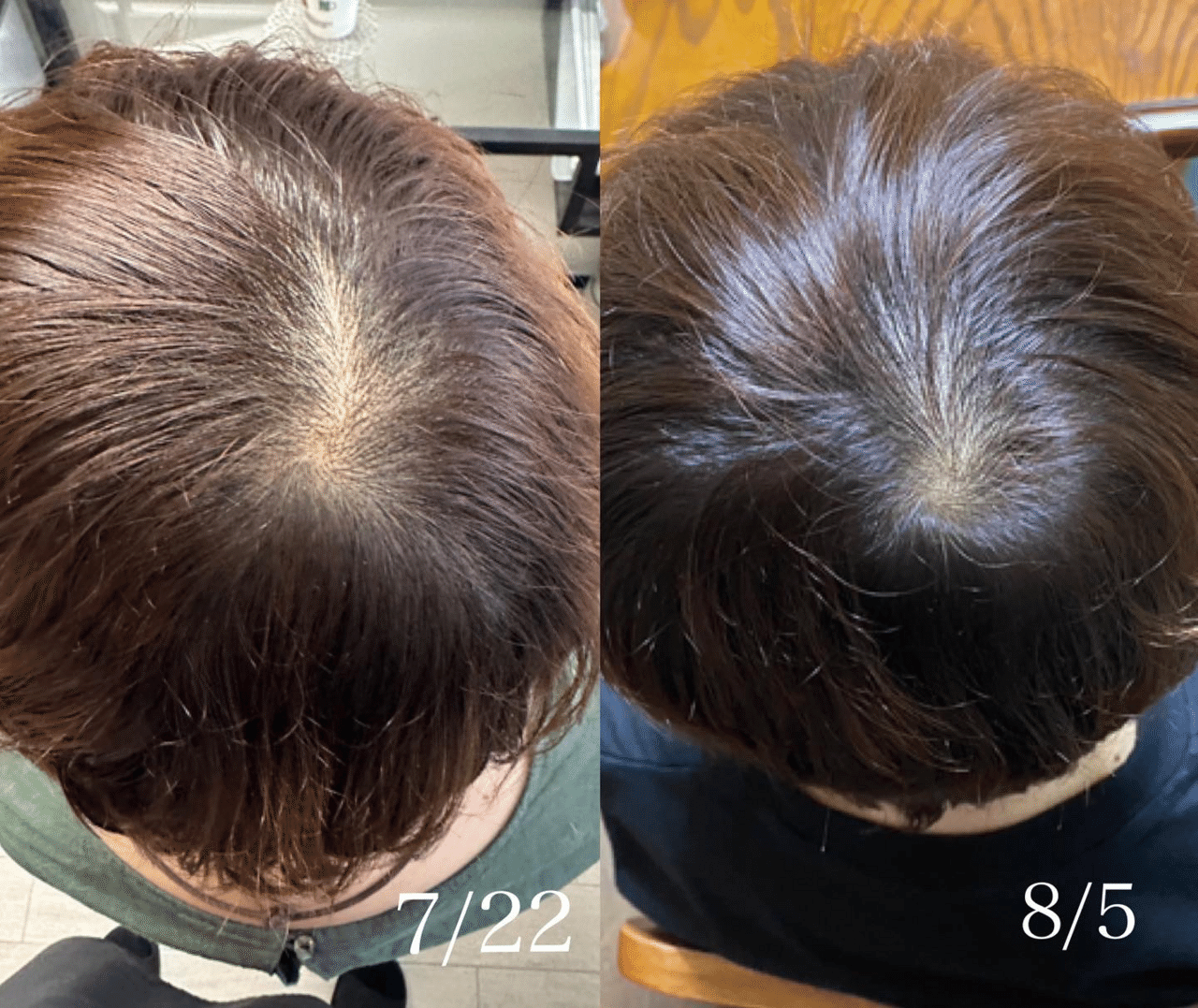 プロセルセラピーズ 頭皮用美容液 5ml×2本 プロセルセラピーズ頭皮｜