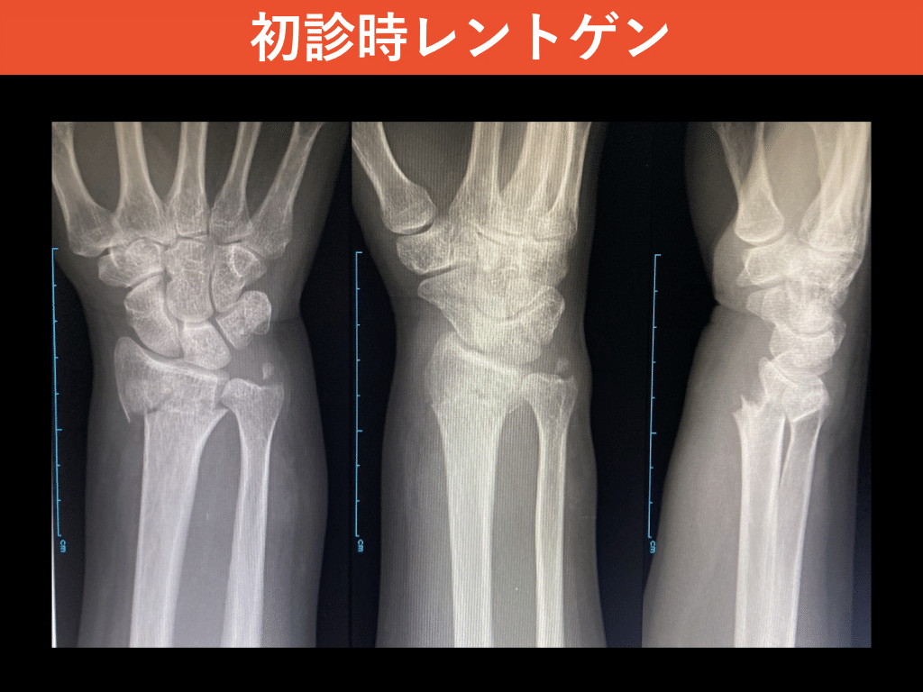 症例報告：橈骨遠位端骨折（AO分類：C2）」＃書く習慣152｜整形外科で