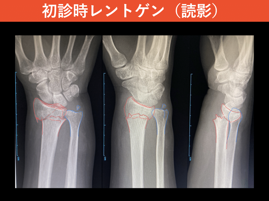 症例報告：橈骨遠位端骨折（AO分類：C2）」＃書く習慣152｜整形外科で