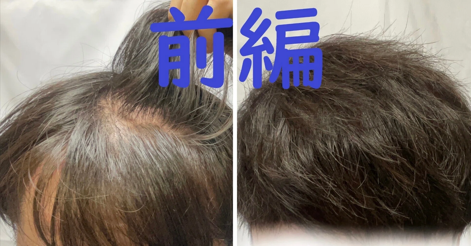 若ハゲのための邪道ヘアセット（前編）！！全スカM字ハゲ必見！！｜ぶる