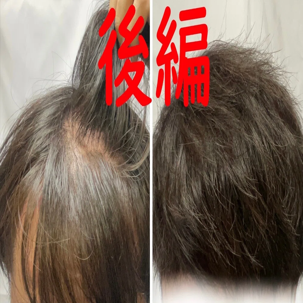 若ハゲのための邪道ヘアセット（後編）！！全スカM字ハゲ必見！！｜ぶる