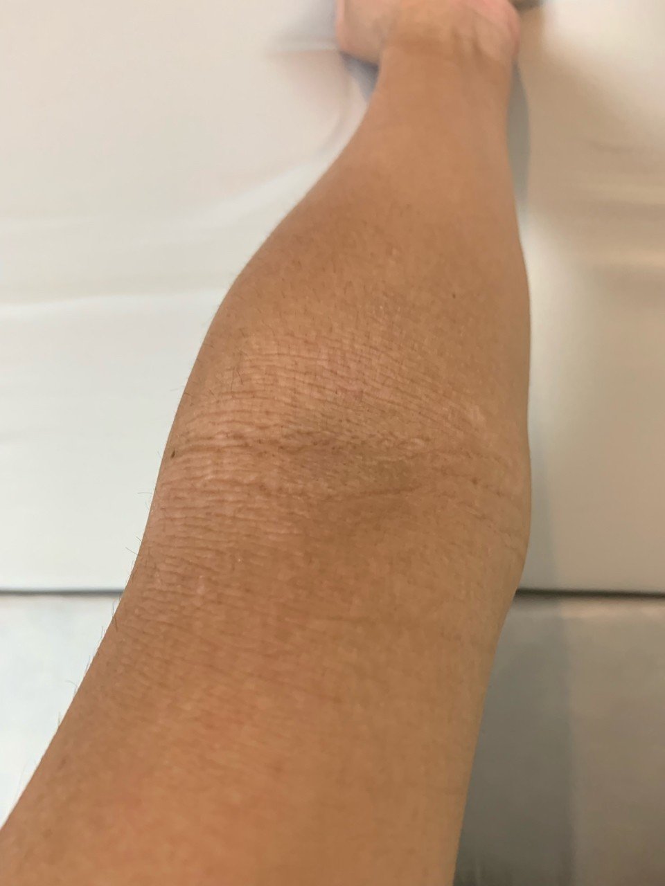 脱ステ14年 腕のアトピー記録 4月26日 アトピー脱ステ14年のトモヤ Note