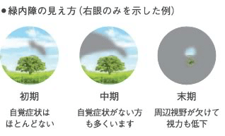 眼球の構造 見え方の仕組み と視機能について メガネくん 盲学校 特別支援学校からの発信 Note