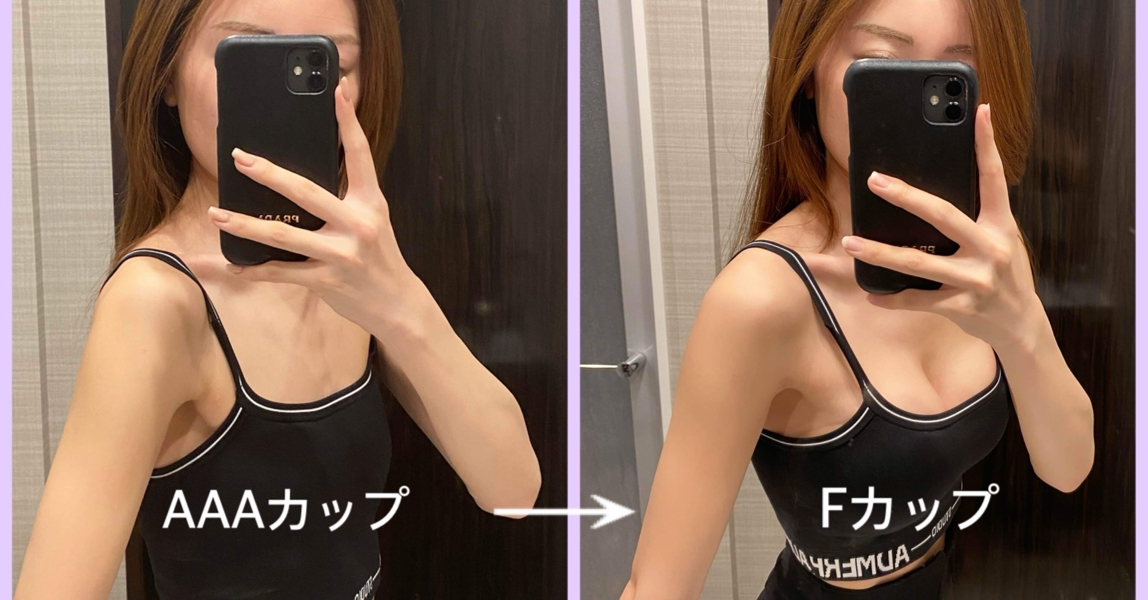 AAAサイズ おっぱい 60万でAAAカップ→Fカップ。豊胸クリニックの執刀医・レポ全公開｜tamagochan_ol