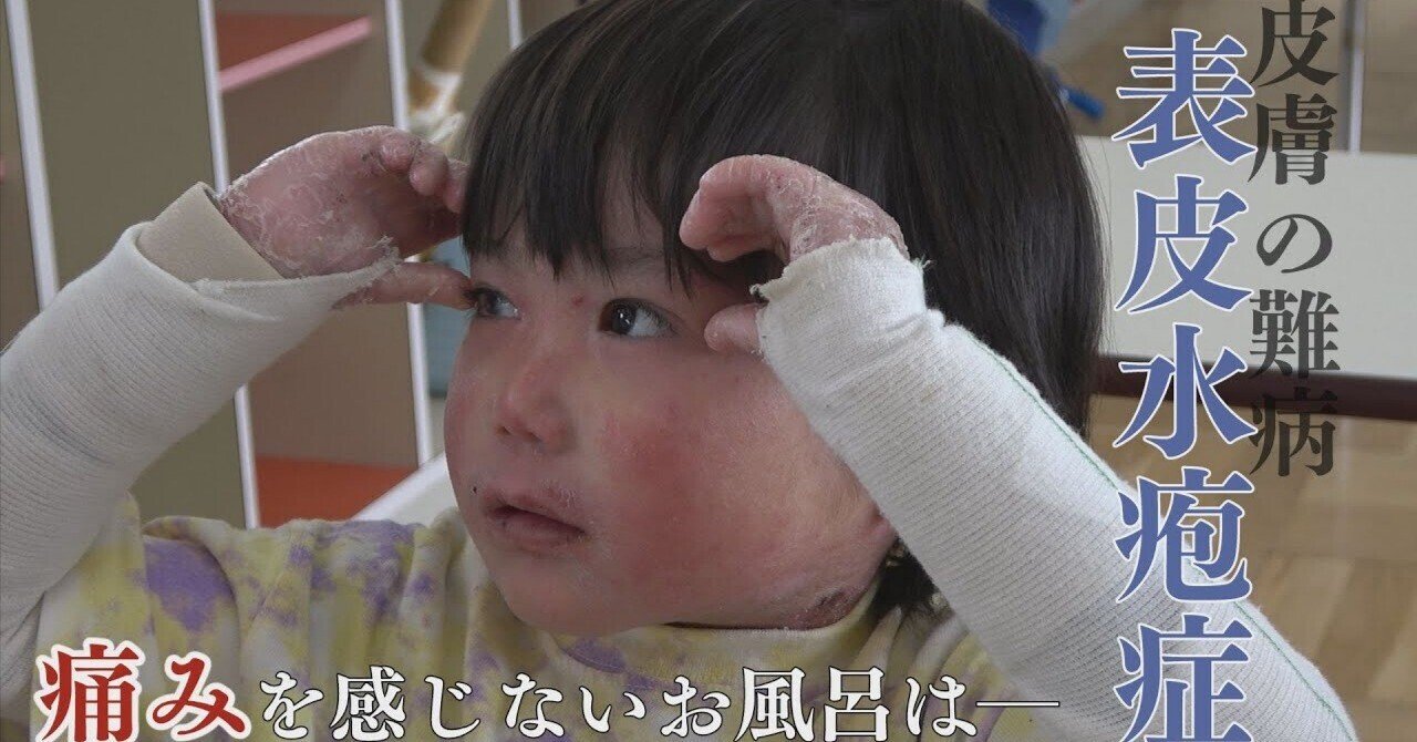 田邉柊くんの日常：表皮水疱症という難病との闘い｜Healthround