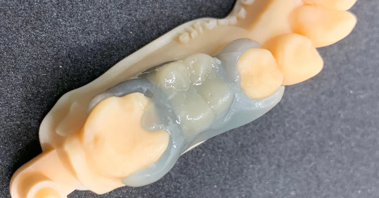 Medit SplintとMedit Designを使用したパーシャルデンチャー作成の方法（歯のデジタル抜歯方法は無料公開中） 2023年11 ...