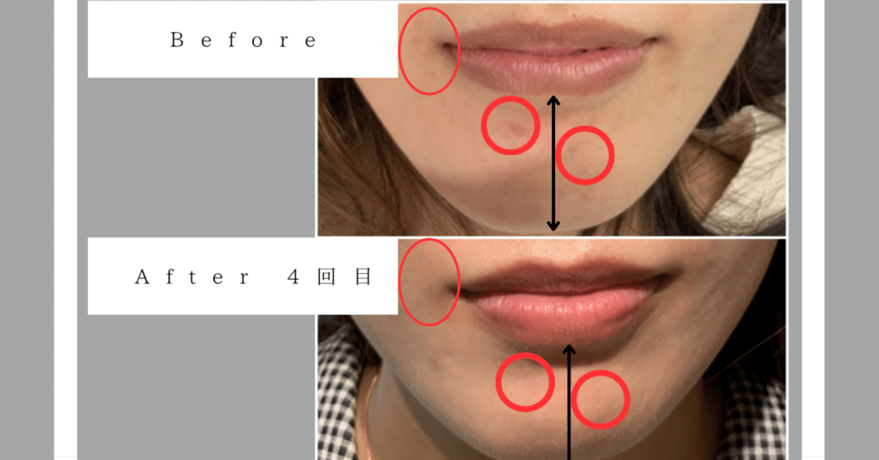 ターンオーバーを促進させるフォトフェイシャル♪｜脱毛専門サロン