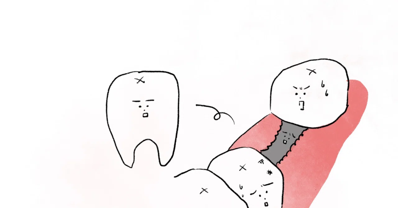 Does Tooth Extraction Hurt? A One-Week Post-Extraction Experience ...