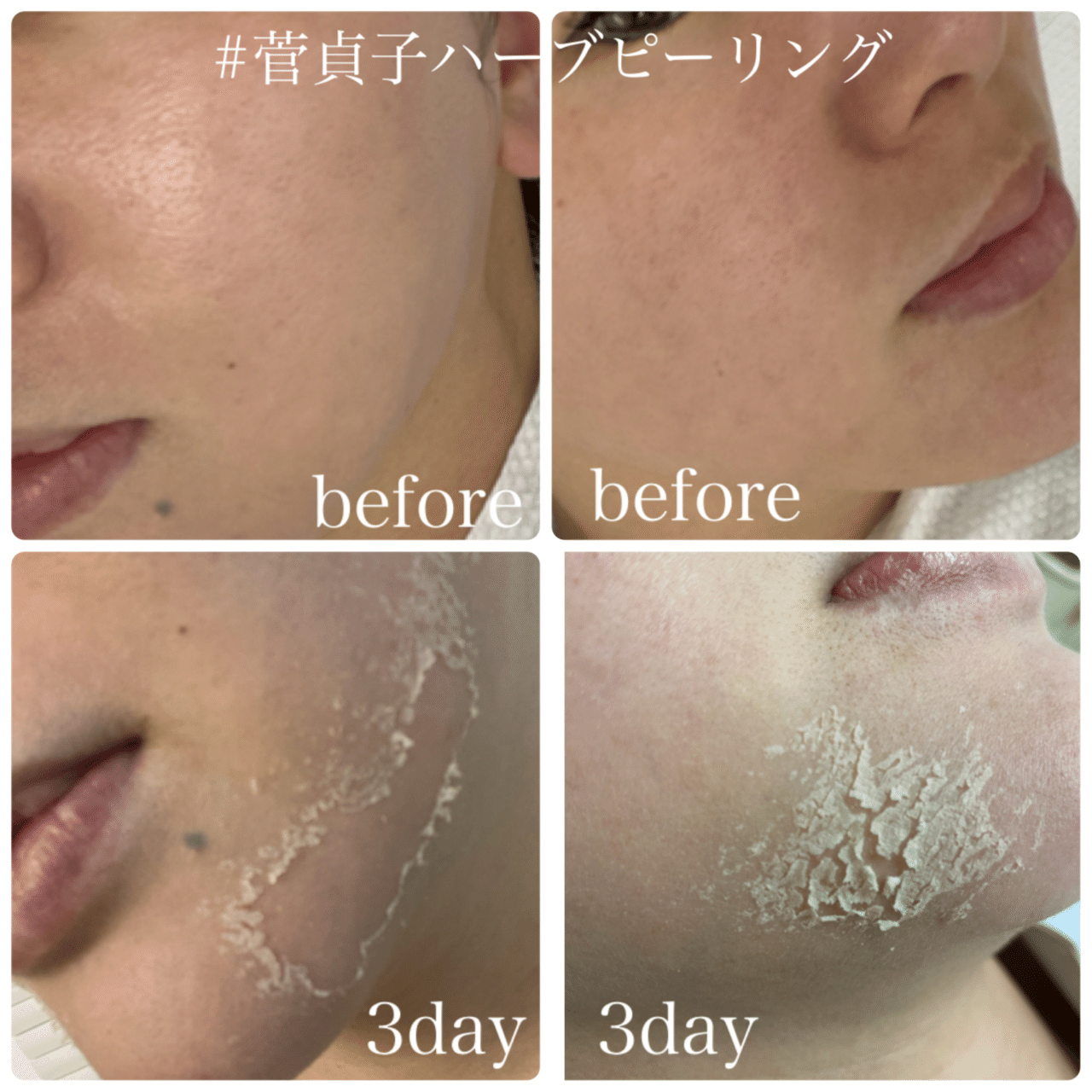 koyo　【新品】菅貞子　ハーブピーリン Amazon.co.jp: 【UVクリーム・日焼け止め】菅貞子 ハーブ