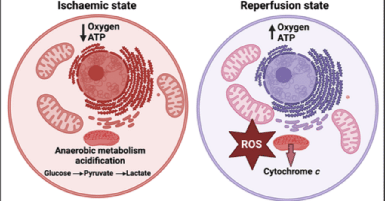 関節リウマチ、ロングCOVID、ME/CFSなどの慢性再発性疾患における虚血再灌流傷害の潜在的役割：エビデンス、メカニズム、治療的意味合い｜哉百名