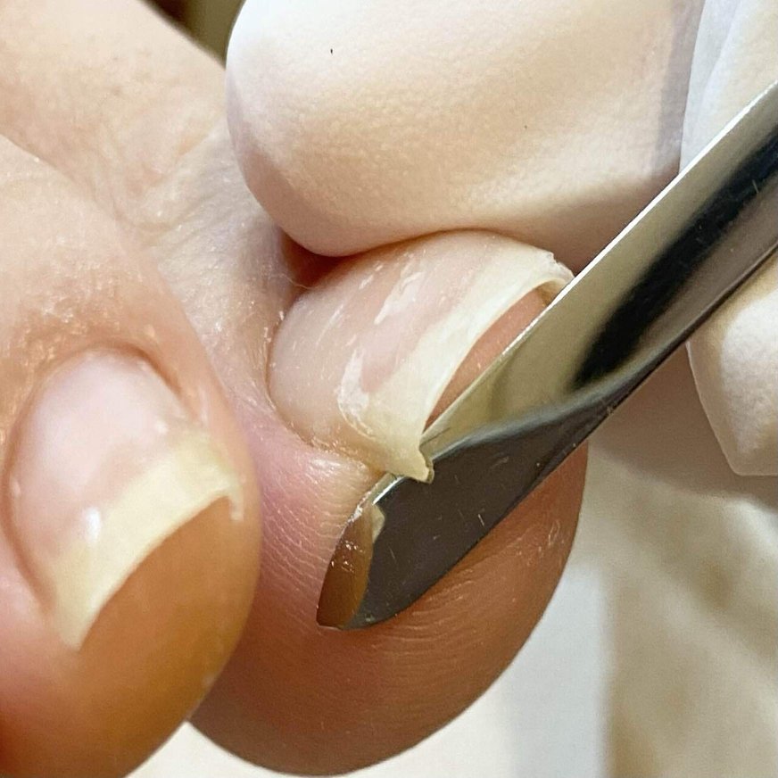 秋以降のフットケアは、足の爪切りから始めよう！ - 爪のいろいろな  