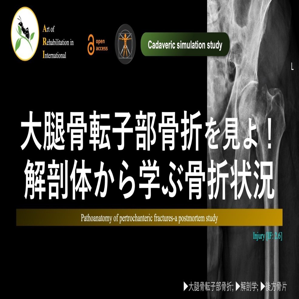大腿骨転子部骨折を見よ！解剖体から学ぶ骨折状況｜Super Human