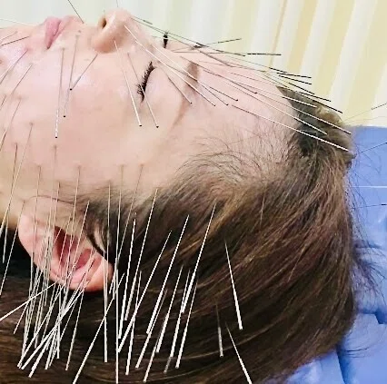 ルート治療。鬼美容鍼。凝り、浮腫みを根こそぎ取る。遺伝の凝りも取る。邪気を取り気を流す。健康全般、不調、運気、金運、顔、精神、才能開花。全てが ...