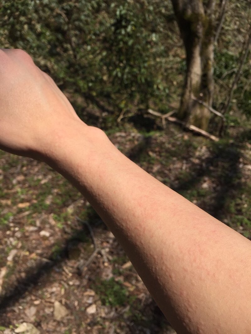 減汗性コリン性蕁麻疹 ゆうと フリーランスセラピスト Note