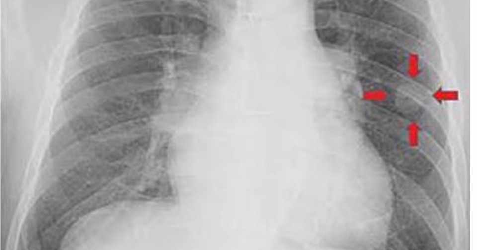 肺結節 ってなに でんなほ Note