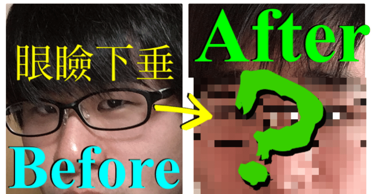 眼瞼下垂の嘘 騙されないで アサキユメミ Note