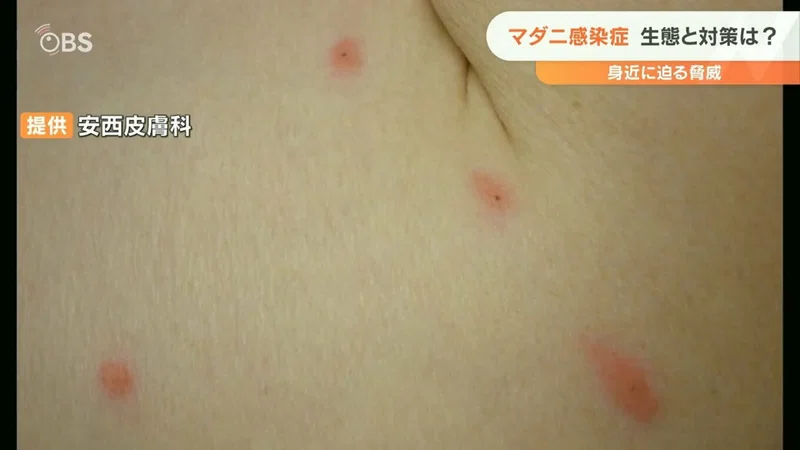 リベンジ登山していたら、、マダニに刺された😥｜ゆるり