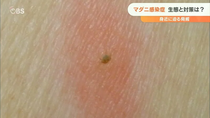 リベンジ登山していたら、、マダニに刺された😥｜ゆるり