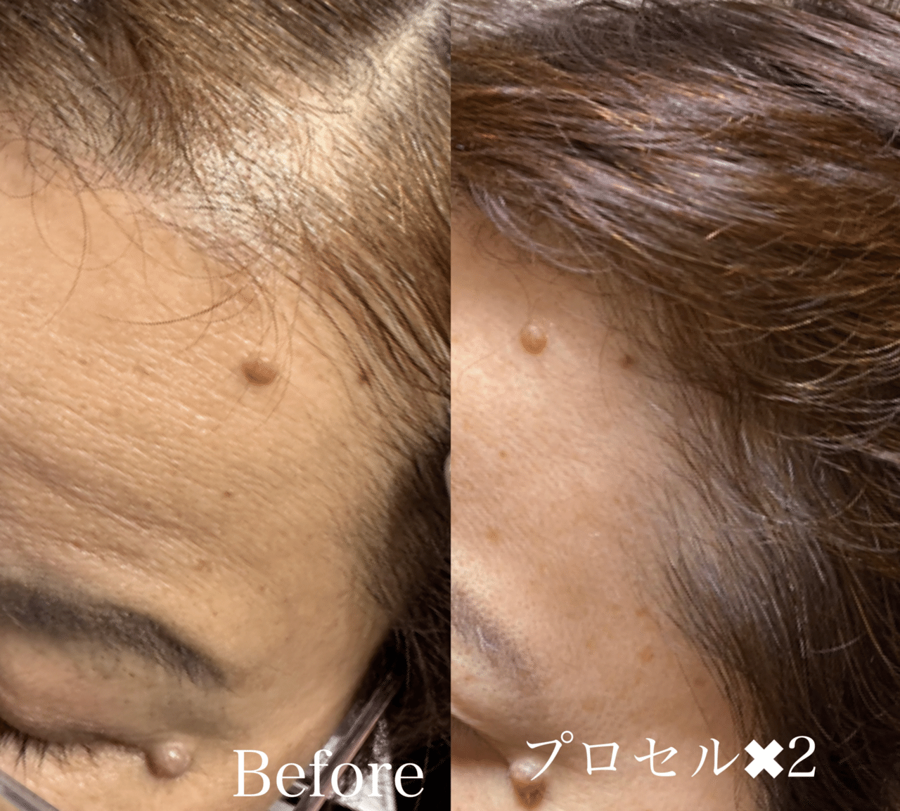 プロセルセラピーズ】2回でしっかり！髪の質もよくなり喜んでいただき