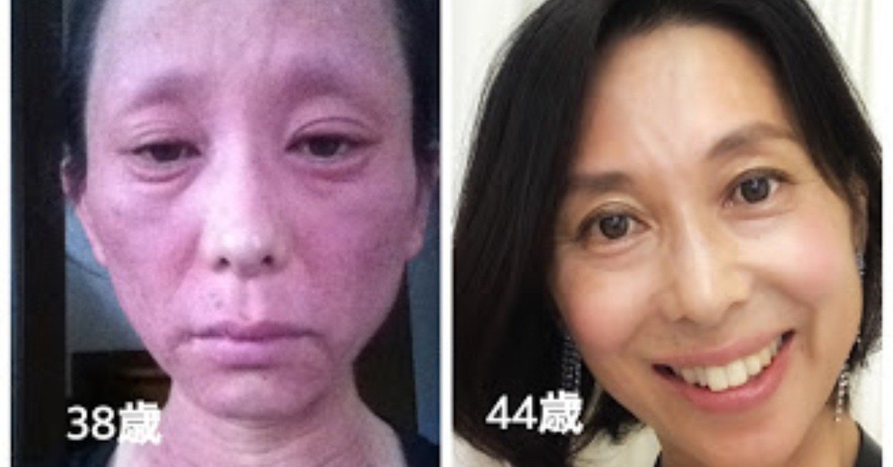 ある日 こんな顔になってしまったら アトピーの再来 神保あゆ 顔ヨガ 自分の力で自分の顔をデザインする Note ある日 こんな顔になってしまったら アトピーの再来 神保あゆ 顔ヨガ 自分の力で自分の顔をデザインする Note