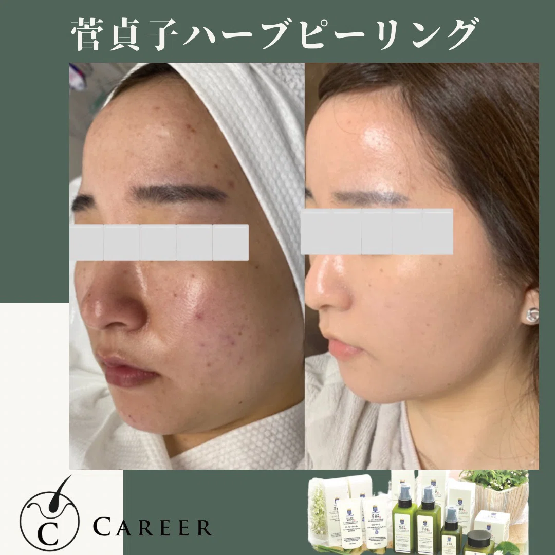 菅貞子ハーブピーリング認定講師です。｜エステ•スカルプ講師